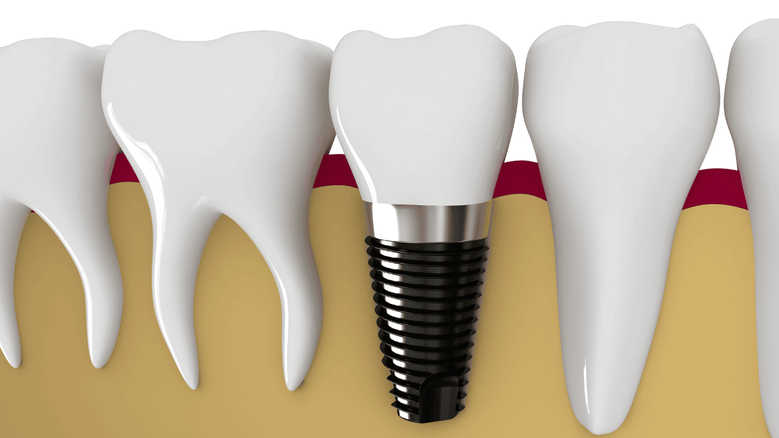 Does Medicare Cover Dental Implants - Why Dental Care Coverage is so Important?